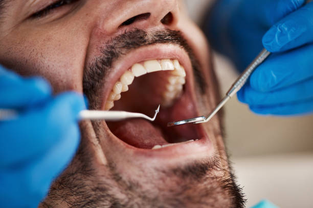 Best Emergency Dentist for Lost Fillings or Crowns in Town Line, NY